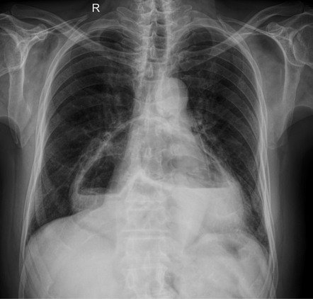 Intrathoracic stomach | Radiology Case | Radiopaedia.org