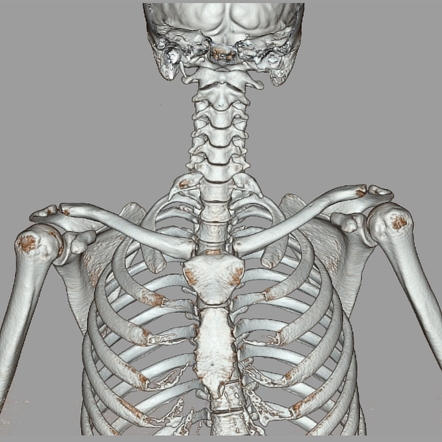 Bilateral cervical ribs | Radiology Case | Radiopaedia.org