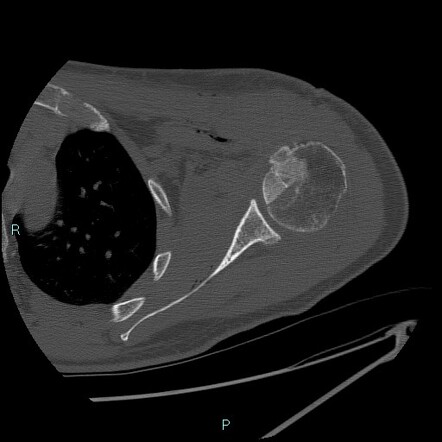 Failure of open reduction with bone grafting of reverse Hill-Sachs ...