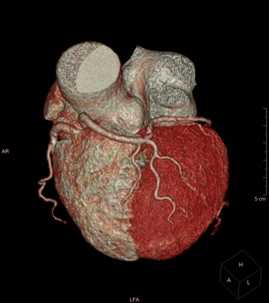 Prepulmonic coronary course | Radiology Reference Article | Radiopaedia.org