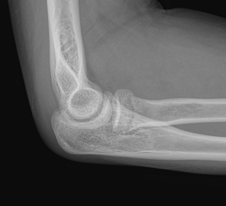 Radial neck fracture | Radiology Case | Radiopaedia.org