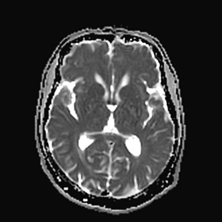 Vestibular Fornix