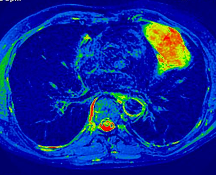 Diffuse large B-cell lymphoma (DLBCL) | Radiology Case | Radiopaedia.org