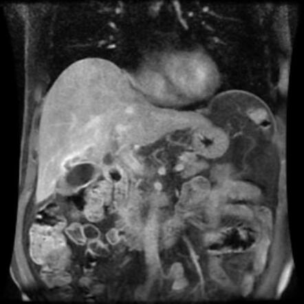 Perforated Acute Calculous Cholecystitis With Hepatic Abscesses ...