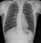 Egg and banana sign (pulmonary hypertension)