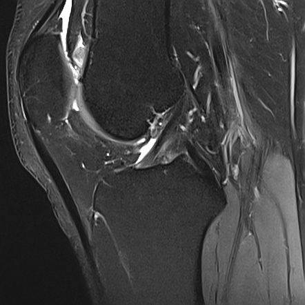 Prefemoral Fat Pad Impingement Syndrome 