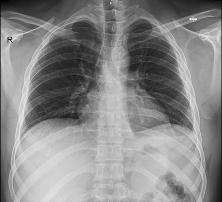 Lamellar pleural effusion | Radiology Case | Radiopaedia.org