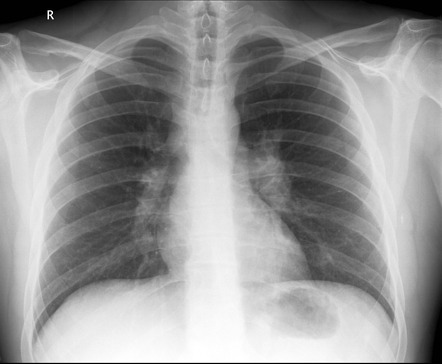 Löfgren syndrome | Radiology Reference Article | Radiopaedia.org