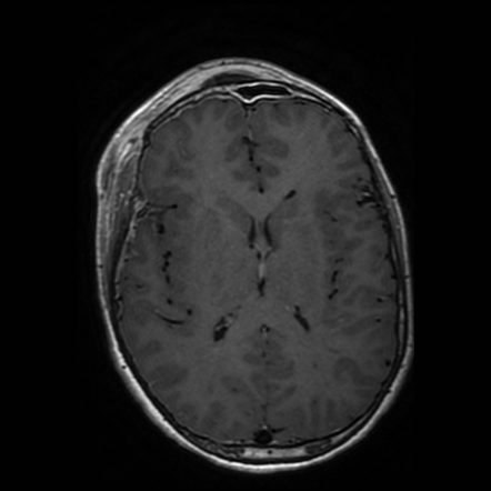 Pott Puffy Tumor | Radiology Case | Radiopaedia.org