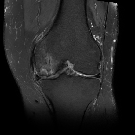 Spontaneous osteonecrosis of the knee (SONK) | Radiology Case ...