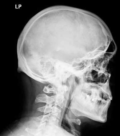 Arcuate foramen | Radiology Case | Radiopaedia.org