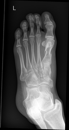 First metatarsal shaft fracture | Radiology Case | Radiopaedia.org