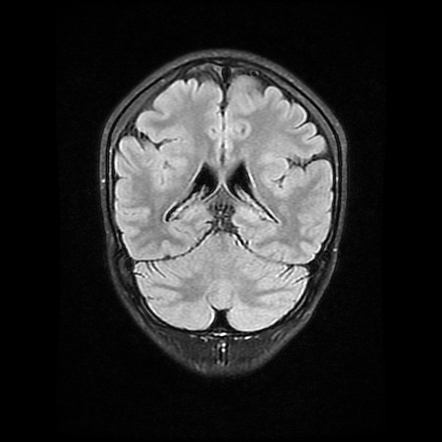 Polymicrogyria | Radiology Case | Radiopaedia.org