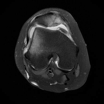 Transient lateral patellar dislocation | Radiology Case | Radiopaedia.org