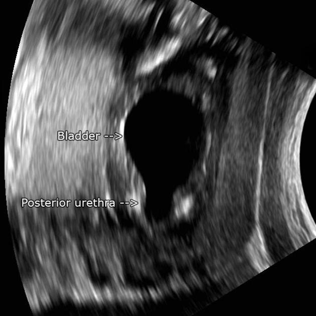 Keyhole sign (disambiguation) | Radiology Reference Article ...