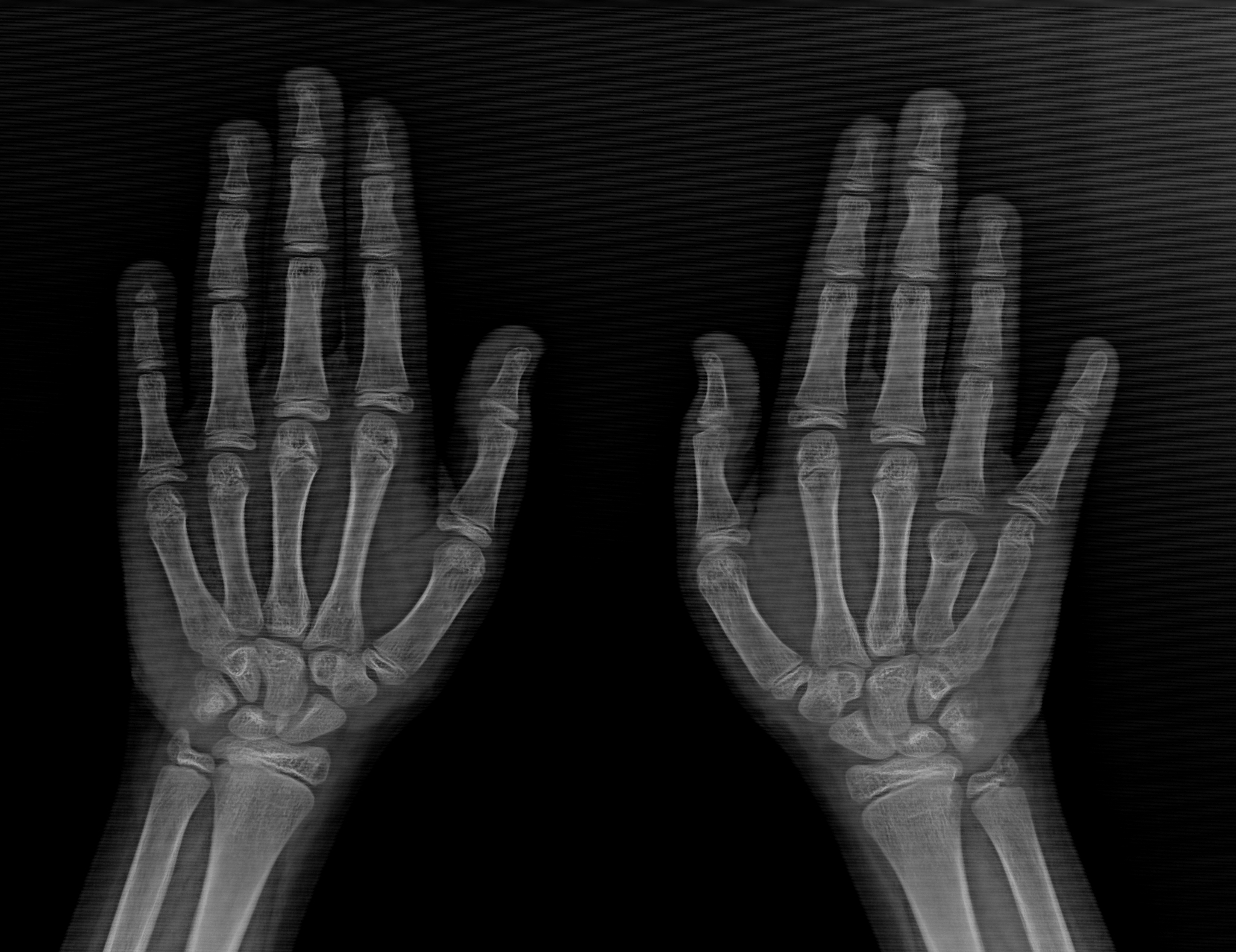 File:Turner syndrome - short fourth and fifth metacarpals ...