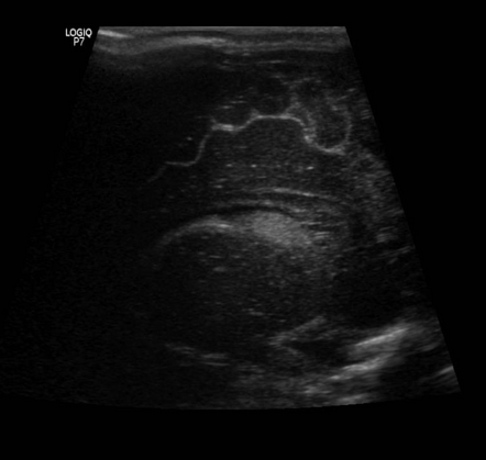 Germinal matrix haemorrrhage - grade II | Radiology Case | Radiopaedia.org