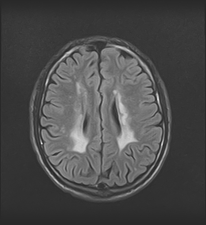 Leukoencephalopathy with brainstem and spinal cord involvement and ...