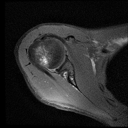 Anterior glenohumeral instability - Hill-Sachs defect and Bankart ...