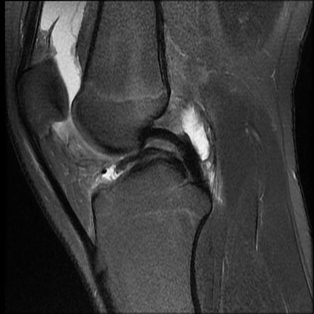 Bucket handle tear - medial meniscus | Radiology Case | Radiopaedia.org