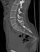 Coccydynia Radiology Reference Article Radiopaedia Org