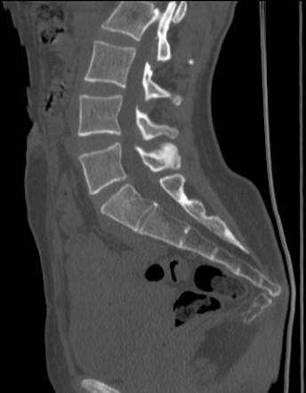 Anterior angulation of the coccyx and bilateral accessory sacroiliac ...