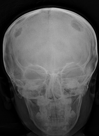 Multiple Lucent Lytic Bone Lesions Mnemonic Radiology Reference Article Radiopaedia Org