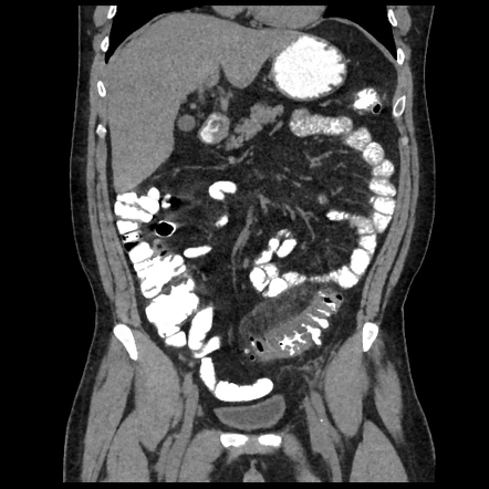 Sigmoid diverticulitis | Radiology Case | Radiopaedia.org