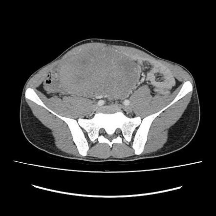 Mesenteric desmoid tumor | Radiology Case | Radiopaedia.org