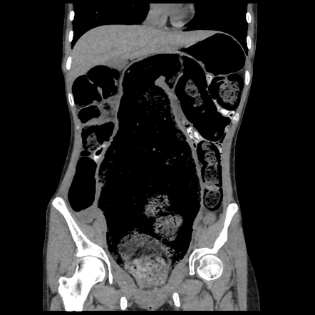 Faecaloma | Radiology Case | Radiopaedia.org