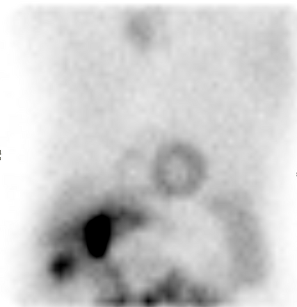 Extracardiac abnormality on myocardial perfusion imaging - thyroid ...