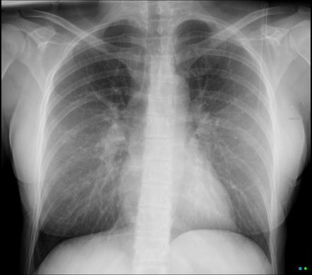 Breast oil cyst (chest x-ray) | Radiology Case | Radiopaedia.org