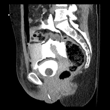 Intraperitoneal bladder rupture | Radiology Case | Radiopaedia.org