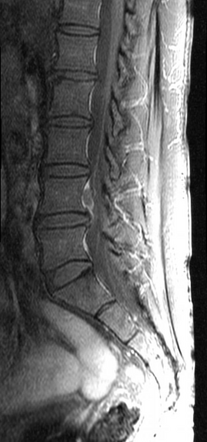 Disc sequestration | Radiology Case | Radiopaedia.org