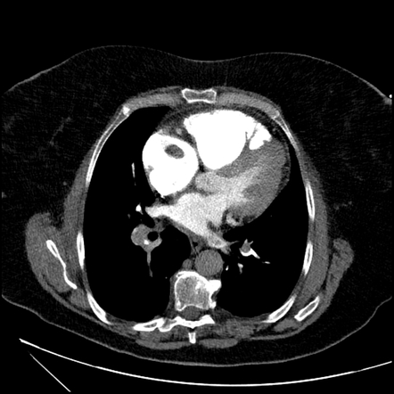 Saddle pulmonary embolism and right atrial thrombus | Radiology Case ...