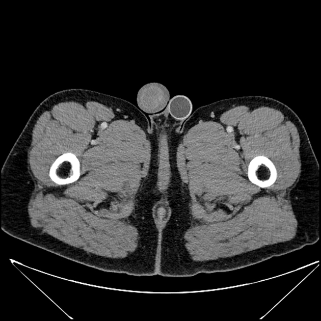 Penile implant Radiology Reference Article Radiopaedia