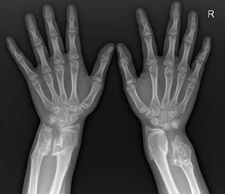 Hereditary multiple exostoses | Radiology Case | Radiopaedia.org