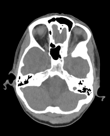 Intraosseous meningioma | Radiology Case | Radiopaedia.org