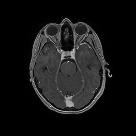 Pleomorphic xanthoastrocytoma | Radiology Reference Article ...