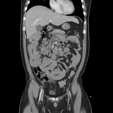 Small bowel lymphoma | Radiology Case | Radiopaedia.org