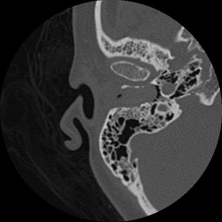 Cholesteatoma | Radiology Case | Radiopaedia.org