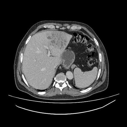 Hepatic abscess | Radiology Case | Radiopaedia.org