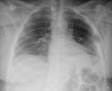 Sternomanubrial dislocation (type 1) causing buffalo pneumothorax ...