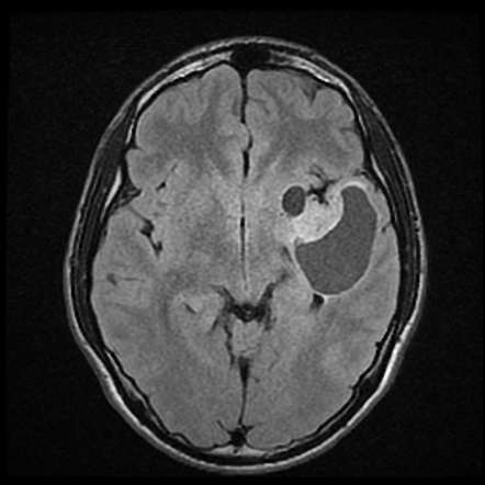 Ganglioglioma | Radiology Reference Article | Radiopaedia.org