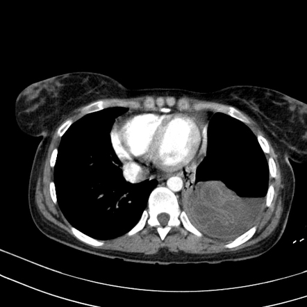 Ruptured pulmonary hydatid cyst | Radiology Case | Radiopaedia.org