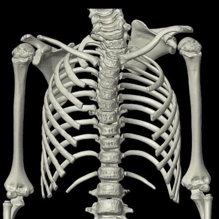 Sprengel Deformity With Klippel-Feil Syndrome | Radiology Case ...