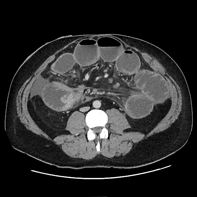 Closed loop small bowel obstruction Radiology Case Radiopaedia