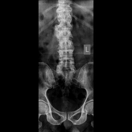 Diffuse idiopathic skeletal hyperostosis (DISH) | Image | Radiopaedia.org