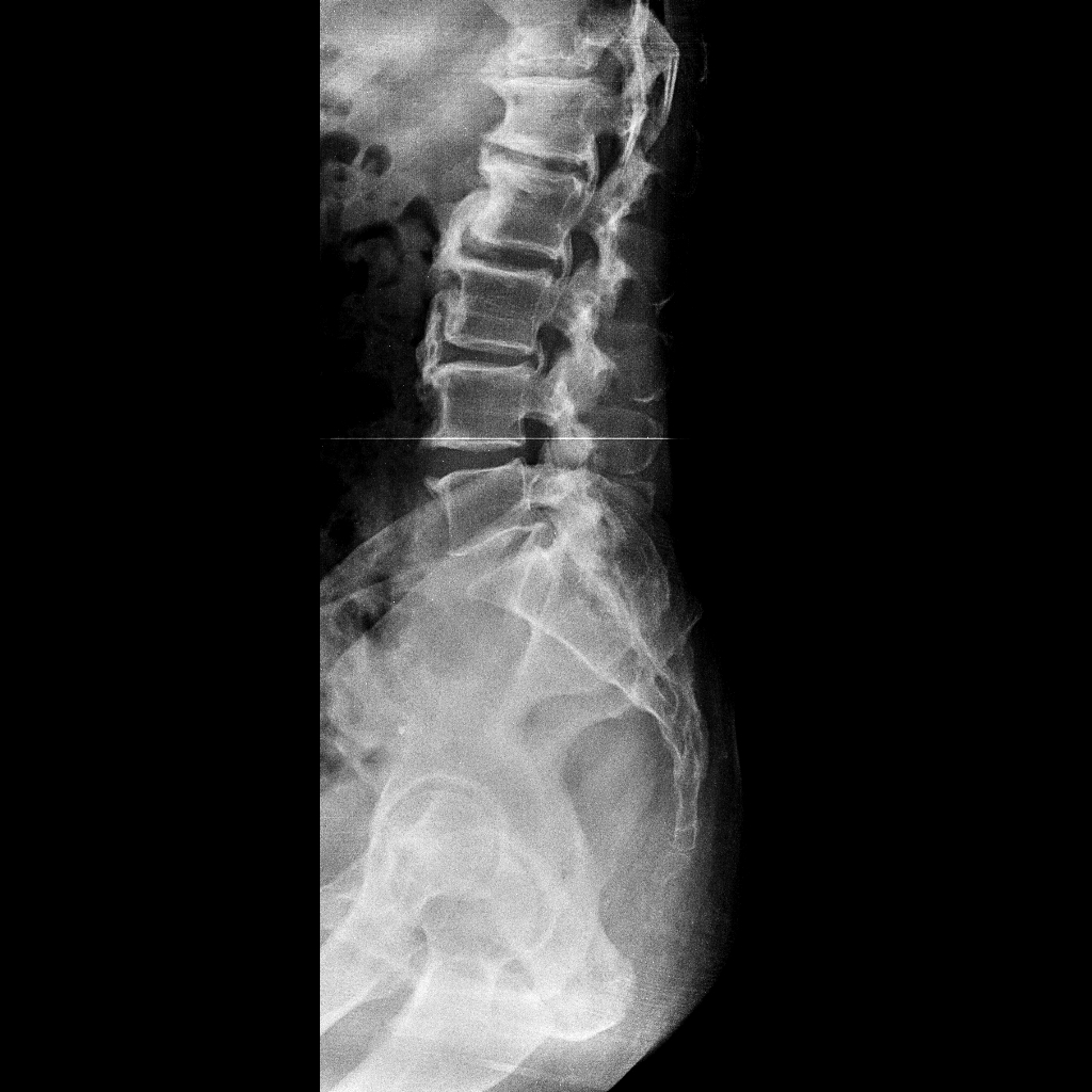 Diffuse idiopathic skeletal hyperostosis (DISH) | Image | Radiopaedia.org