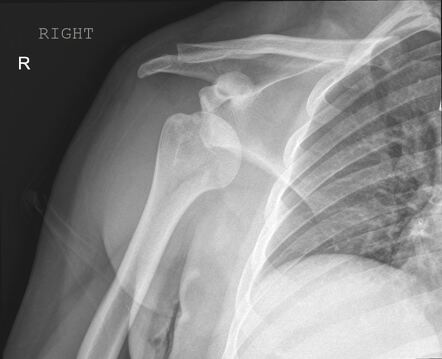 Anterior shoulder dislocation | Radiology Case | Radiopaedia.org